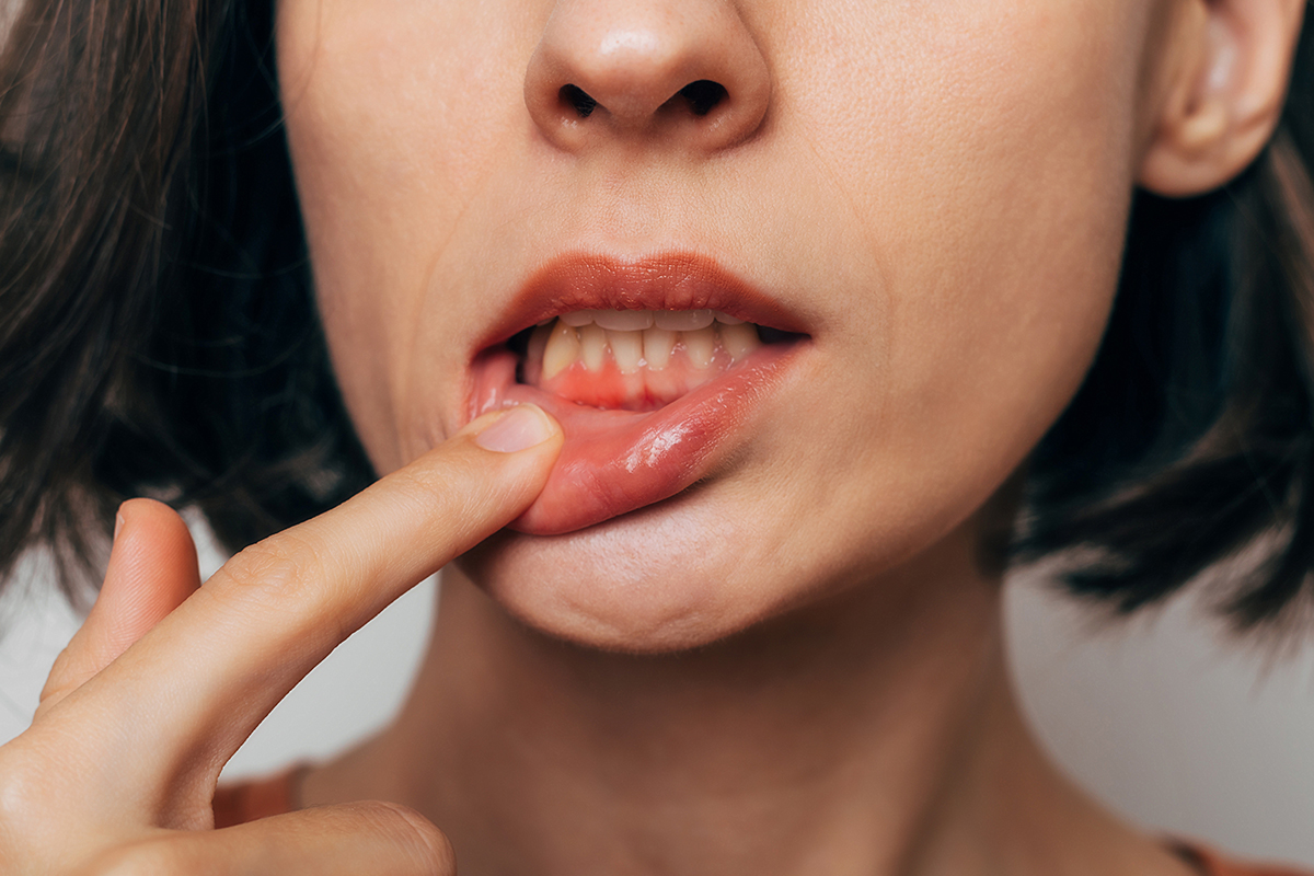 Periodontal Treatment